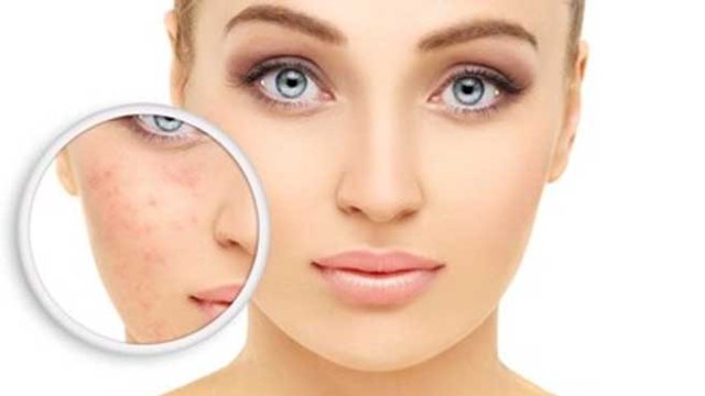 Yüzü kızartan neden: Rozasea