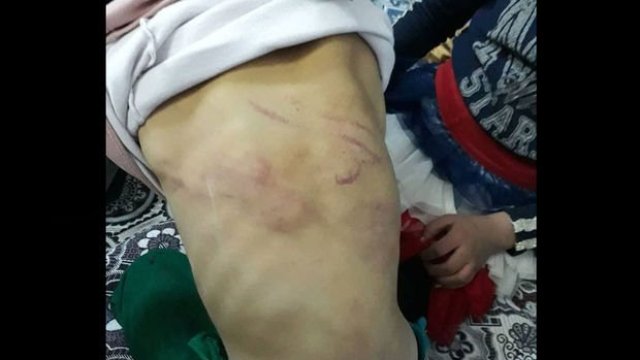 Gaziantep'te babasından işkence gören çocuk yuvaya yerleştirildi