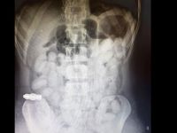 Antalya'da midesinde taşıdığı uyuşturucuyla yakalanan Brezilyalı kuryeye 25 yıl hapis