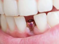 Sahte implantlar nasıl anlaşılır?