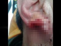 Başakşehir'de bir kişi kavga ettiği şahsın kulağını ısırarak kopardı