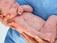 Avrupa'da kızamık vakaları yüzde 400 arttı