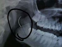 Boğazında unutulan ameliyat iğnesi 18 yıl sonra alındı