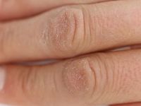 Soğuk yaralanması nedir?