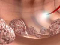 Kalın bağırsak kanserinden korunmanın 7 yolu!