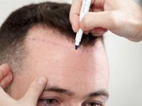 Saç ekimi ne zaman yapılmalı?