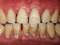 Diş taşlarınızı doğal yöntemlerle yok etmek artık mümkün...