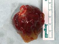 Kalbinden 5cm’lik Tümör Çıkarıldı