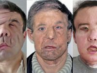 Dünyada ilk kez aynı kişiye ikinci yüz nakli yapıldı