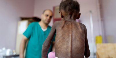 150 milyon çocuk yetersiz besleniyor