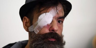 Sarı yelekliler lideri Jerome Rodrıgues plastik mermiyle vuruldu, bir gözünü kaybetti