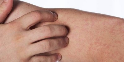 Yılın ilk altı ayında 90 bin kızamık vakası