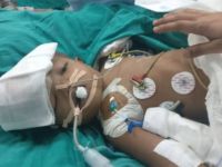 Hindistan'da yapışık ikizler ameliyatla ayrıldı