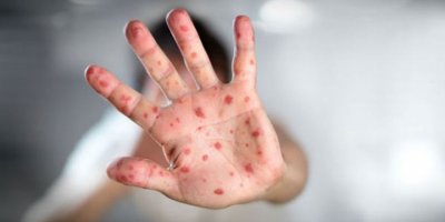 Kızamık vakaları 3 kat arttı! DSÖ salgın alarmı verdi