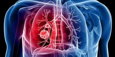 Biyologlar Derneği: “Tüberküloz öldürücü olabilir”