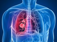 Kanser riskli akciğer nodüllerinde "mavi boya" devrimi