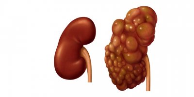 "Polikistik böbrek hastalığı her bin sağlıklı insandan 1'inde görülebilir"