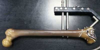 Kırık tedavileri için 'yerli çivi' üretildi