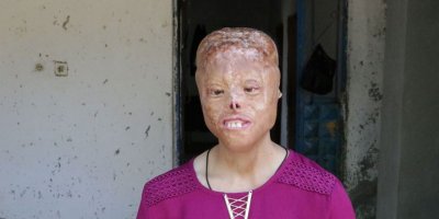 20 yaşındaki Leyla yüz nakli bekliyor: 'Liseye kadar öğretmenim sayesinde okuyabildim, benden korkuyorlardı'