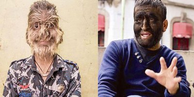 Kusurlu ilaç kurt adam yaptı