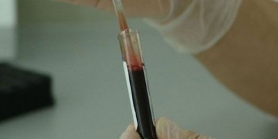 Tek kan testiyle 20 kanser türü tespit edilebiliyor