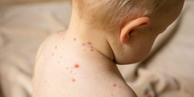 Kızamık, ‘bağışıklık bellek yitimi’ne sebep oluyor