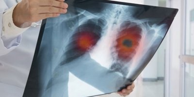 Akciğer kanserinde yeni tedavi yöntemleri sağ kalım süresini artırıyor