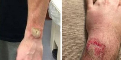 Son dönemde popüler olan akıllı saat uykuda patladı, adam hastanelik oldu