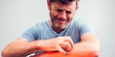 Uyuz tedavisi nasıl yapılır?