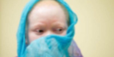 Zambiya’da albinos çocuğun elini kestiler