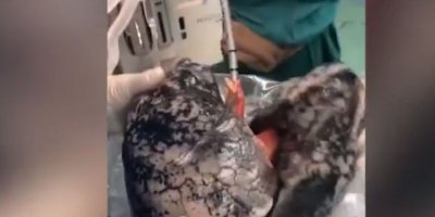 30 yıldır sigara içen kişinin akciğeri 25 milyon kez izlendi: 'En iyi sigara karşıtı reklam'