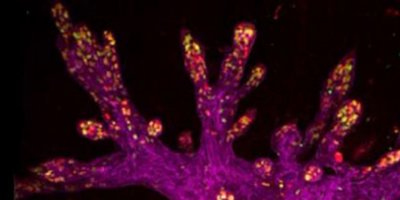 Kanserin ana sebeplerinden biri kronik iltihaplanma