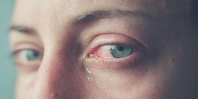 Göz sulanması neden olur?