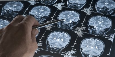 Bilim insanları gençlerin kafatasında büyüme saptadı