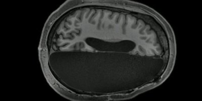 'Beyninin yarısı alınan insanlar normal yaşamını sürdürüyor'