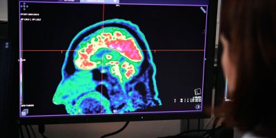 Kaybolan beyin hücreleri yerine geçebilen 'yapay nöronlar' Alzheimer'la mücadelede kullanılabilir