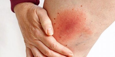 Lyme hastalığı belirtileri ve tedavisi…