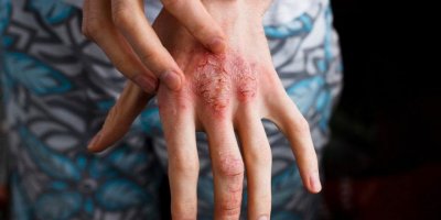 Çocuklarda atopik dermatit belirtileri ve tedavisi…