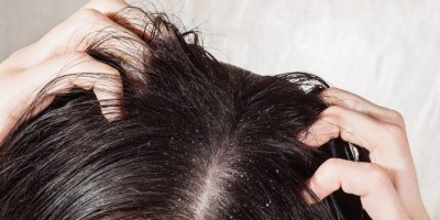 Saç kepeklenmesi nasıl geçer?