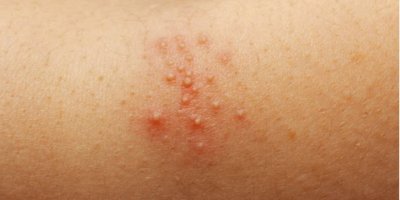 Kızamık salgını 6 bin kişinin ölümüne neden oldu