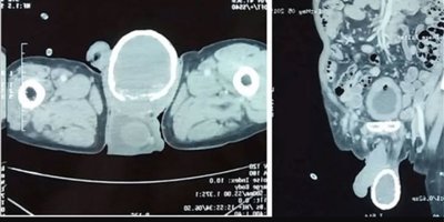 Testis kireçlenmesi nedir?