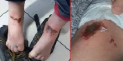 Rektör'den vücutlarında yanık oluşan çocuklar için açıklama