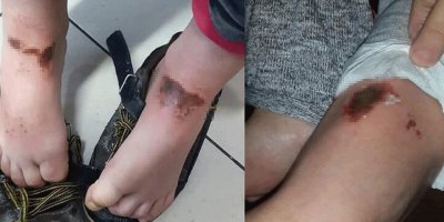 Yanıklar olan çocuklardan patolojik örnek alınmamış