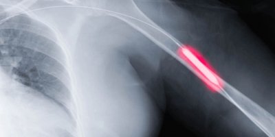 Ölümcül kan pıhtılaşması nasıl önlenir?