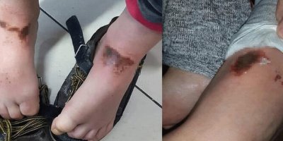 Yanıkların sebebi belli oldu