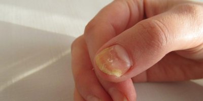 Tırnak sararması nasıl önlenir?