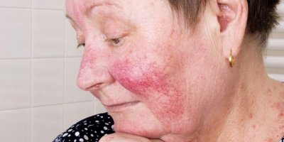 Gül hastalığı bulaşıcı mıdır?