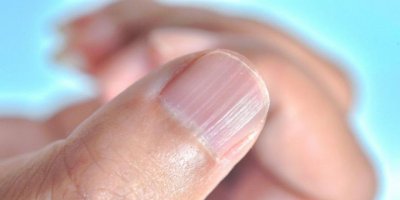 Demir eksikliği belirtileri nelerdir?