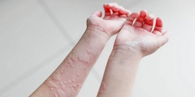 Ürtiker çeşitleri nelerdir?