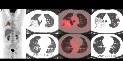 Koronavirüsten ölen hastanın röngen görüntüsü ortaya çıktı